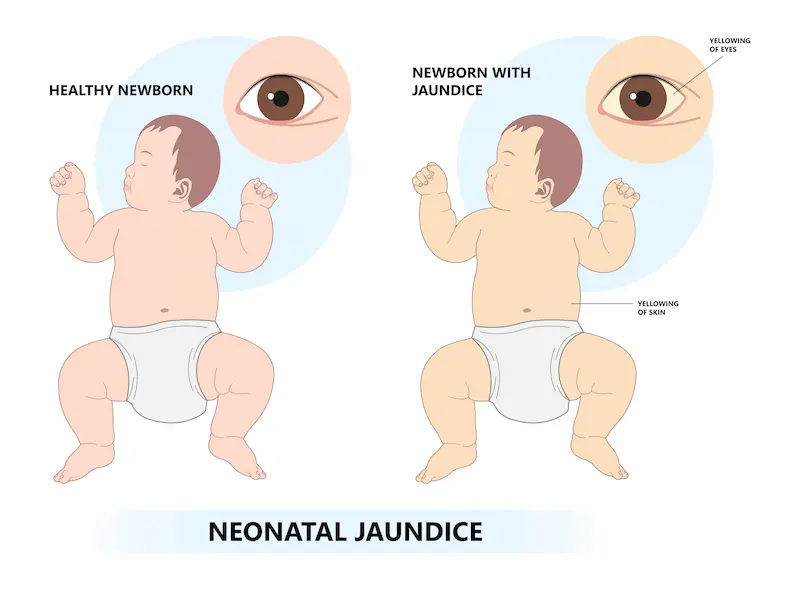 Understanding Neonatal Jaundice Causes and Treatment